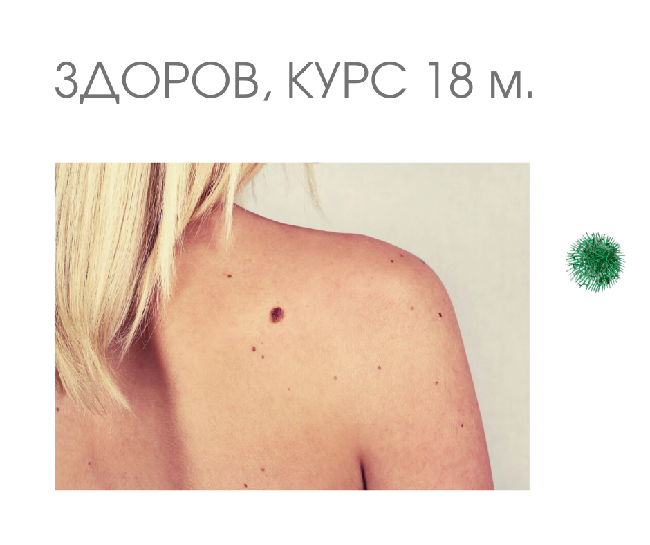 Меланома